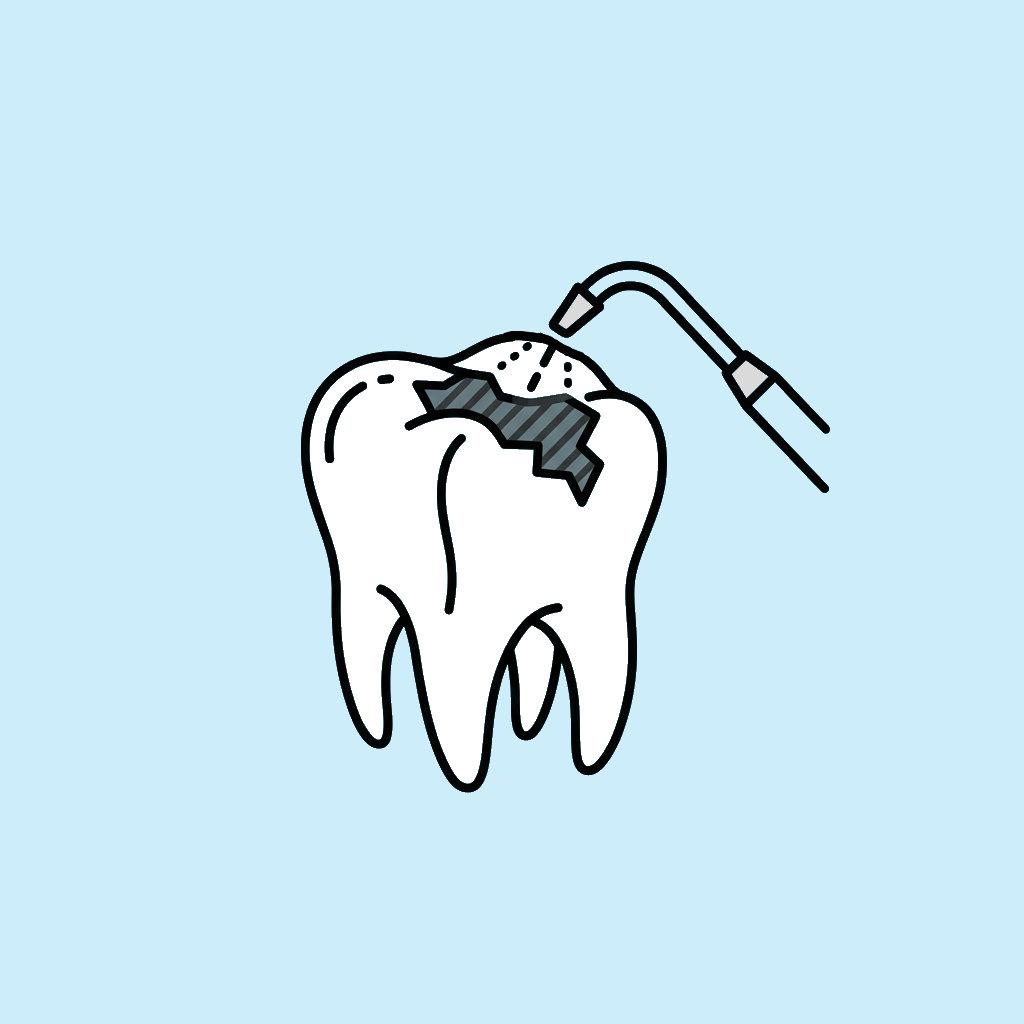 Mercury Amalgam Removal