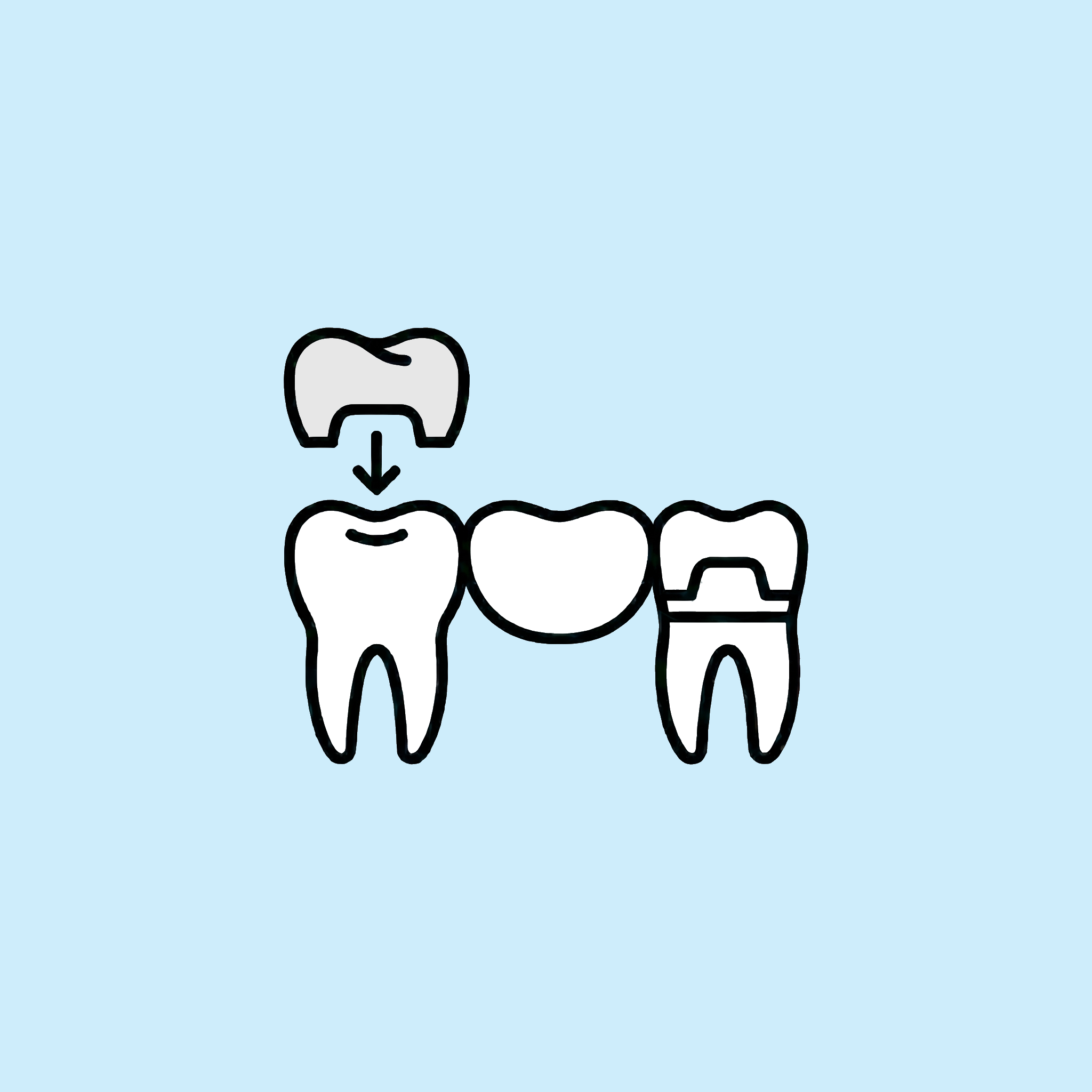 Crowns and Bridges