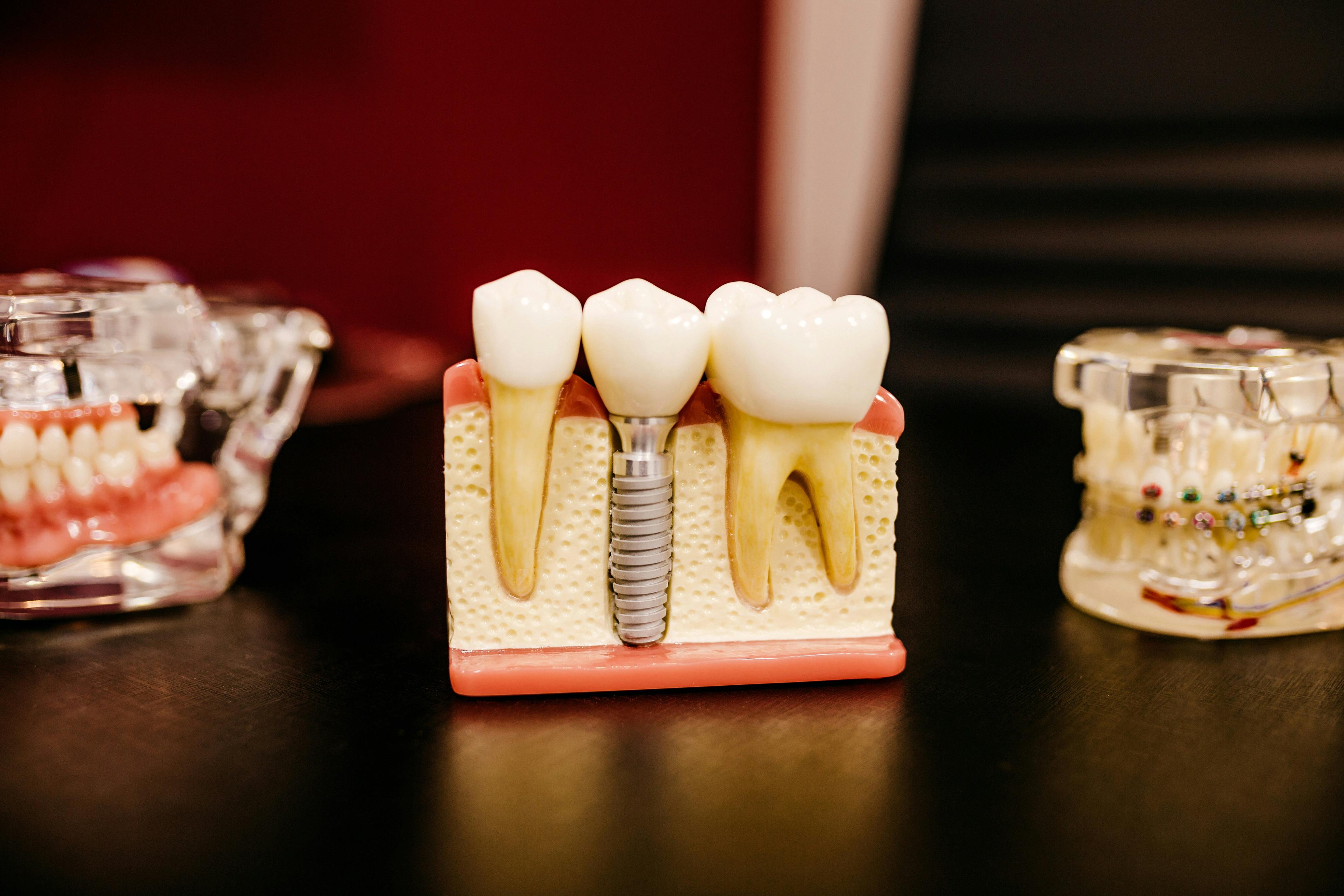 Dental Implants in Somerset West